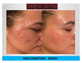 ADVANCED ACNE ATTACK CERTIFICATION CLASS (LEVEL 2) SUNDAY NOVEMBER 13TH, 2022