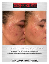 ADVANCED ACNE ATTACK CERTIFICATION CLASS (LEVEL 2) SUNDAY NOVEMBER 13TH, 2022